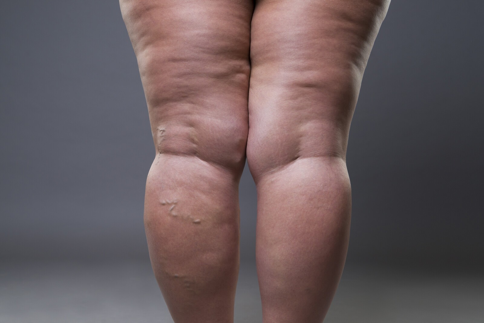 Foto de Compression garments for the treatment of lipoedema and